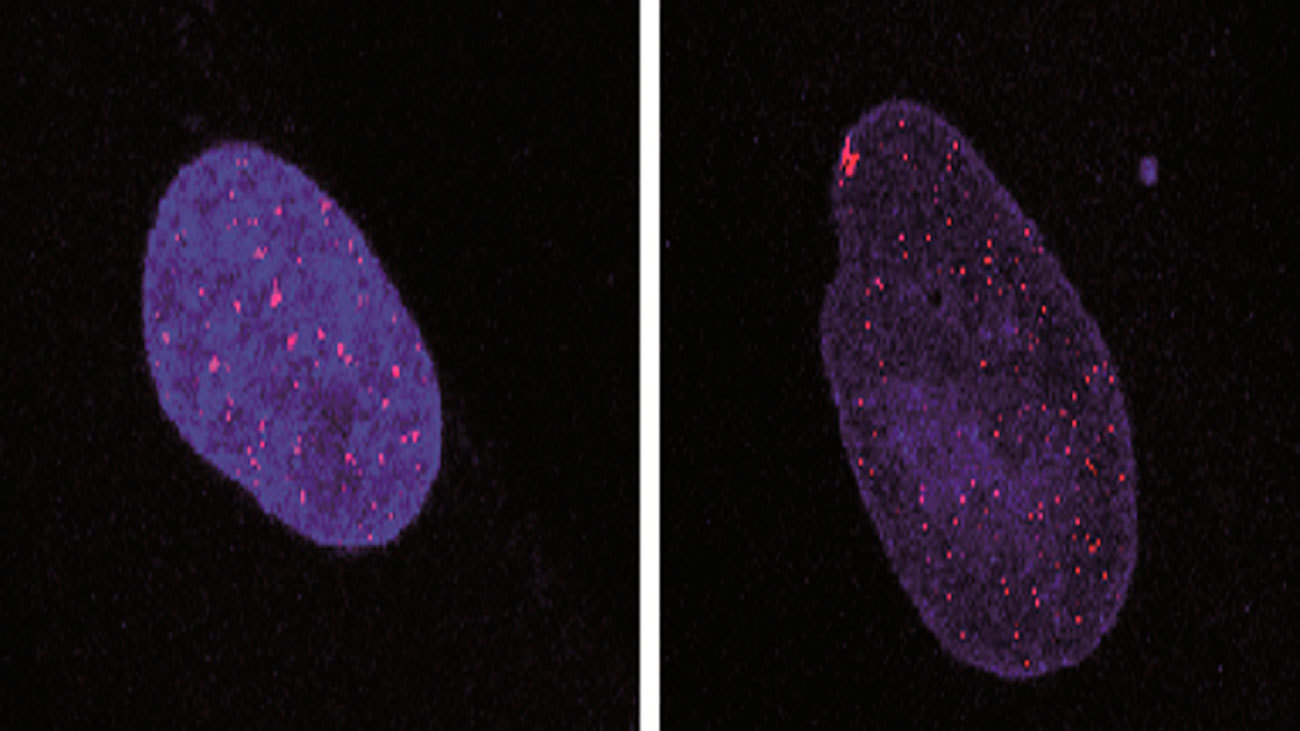 Investigadores españoles hallan una diana terapéutica para la ataxia telangiectasia