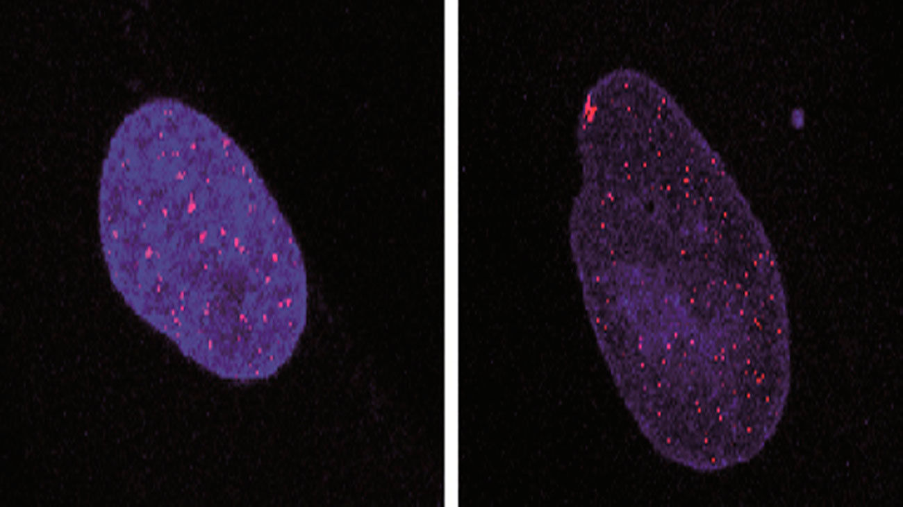 Investigadores españoles hallan una diana terapéutica para la ataxia telangiectasia