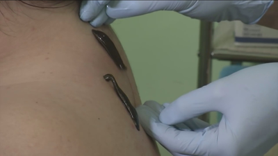 Doctora Sanguijuela, pseudoterapias medievales en Madrid