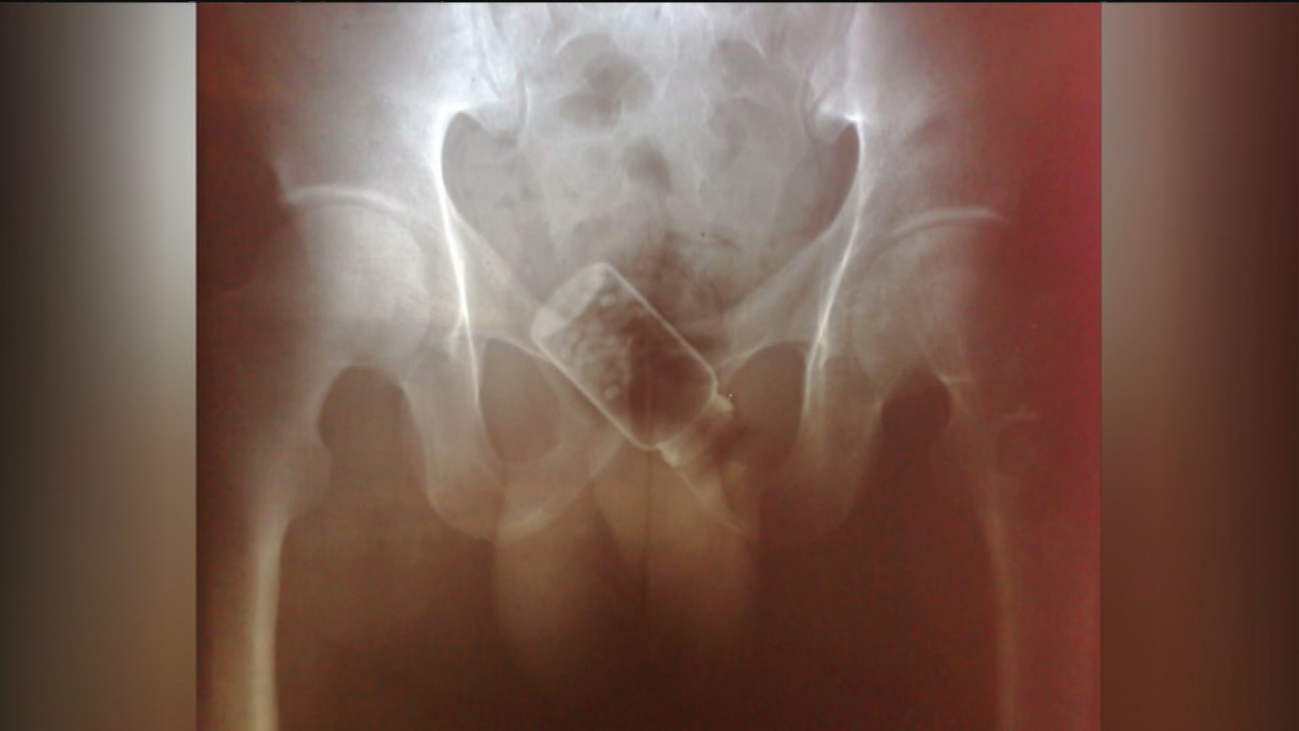 Las radiografías que muestran cómo se introduce la droga en las cárceles