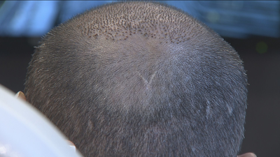 Los implantes de pelo, un negocio en auge en España