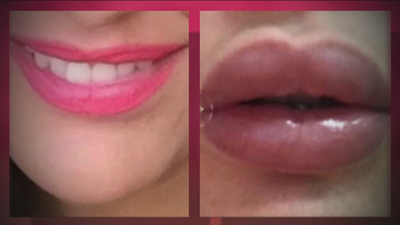 Detenida en Canarias por realizar cirugías estéticas de labios con silicona