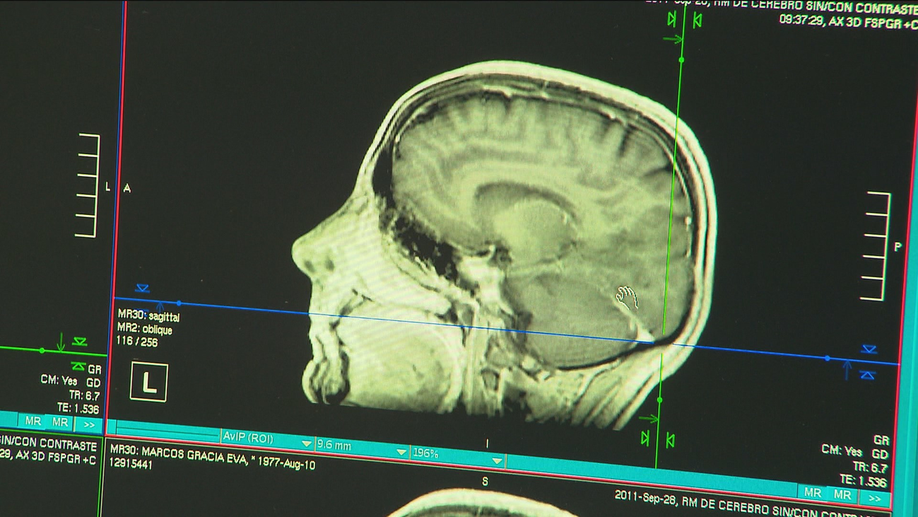 Consiguen reducir  los recuerdos selectivamente con un anestésico