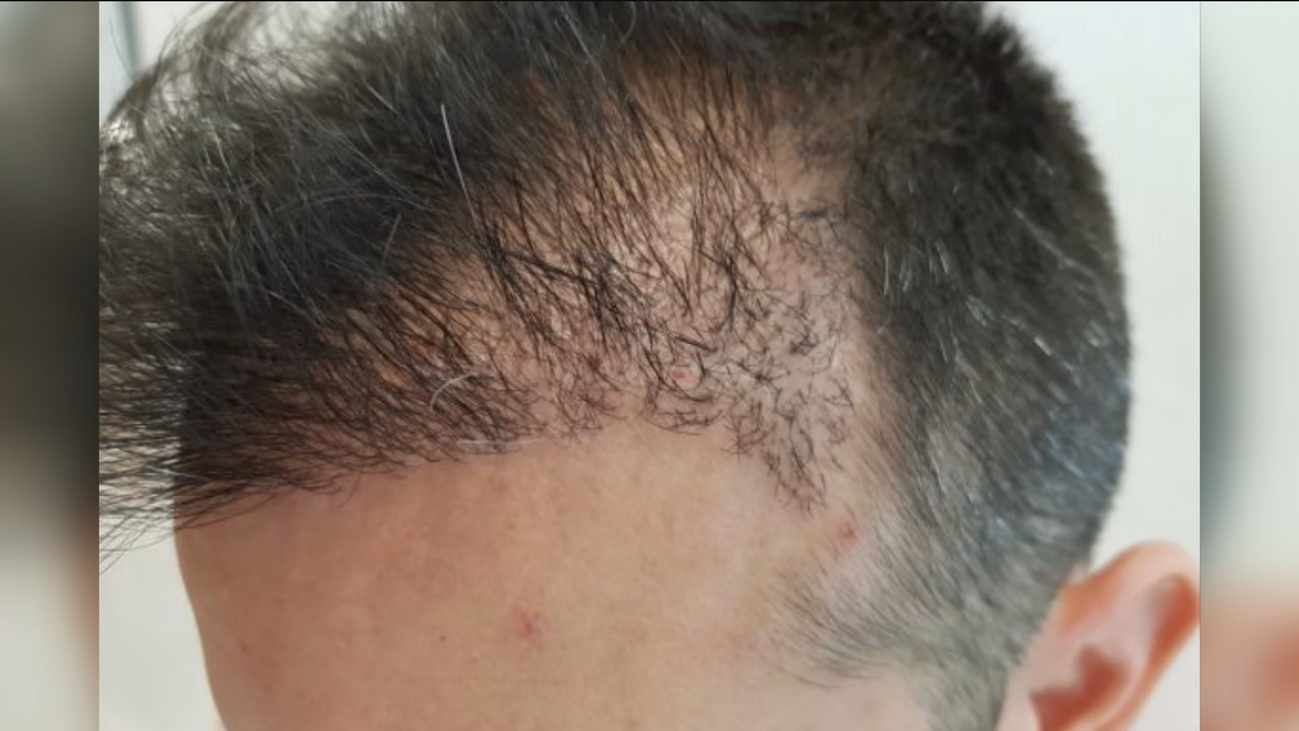 Los riesgos de los transplantes capilares "low cost"
