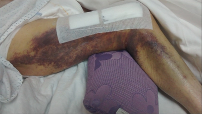 Una anciana pasa tres días con la pierna rota en una residencia de Colmenar Viejo