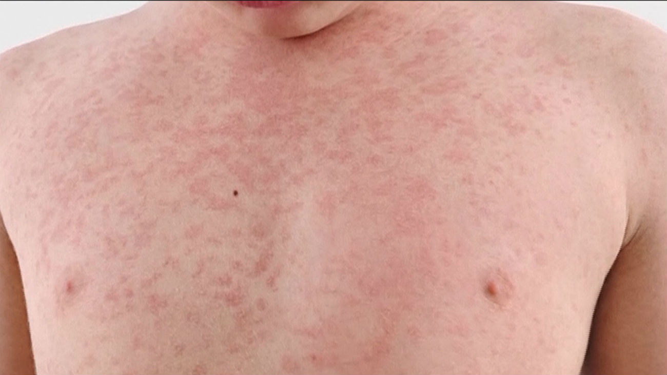 El peor brote de sarampión en 25 años