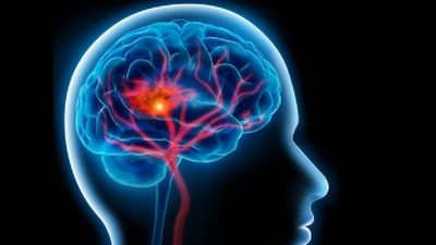 Haber sufrido un ictus triplica el riesgo de morir tras superar la covid-19