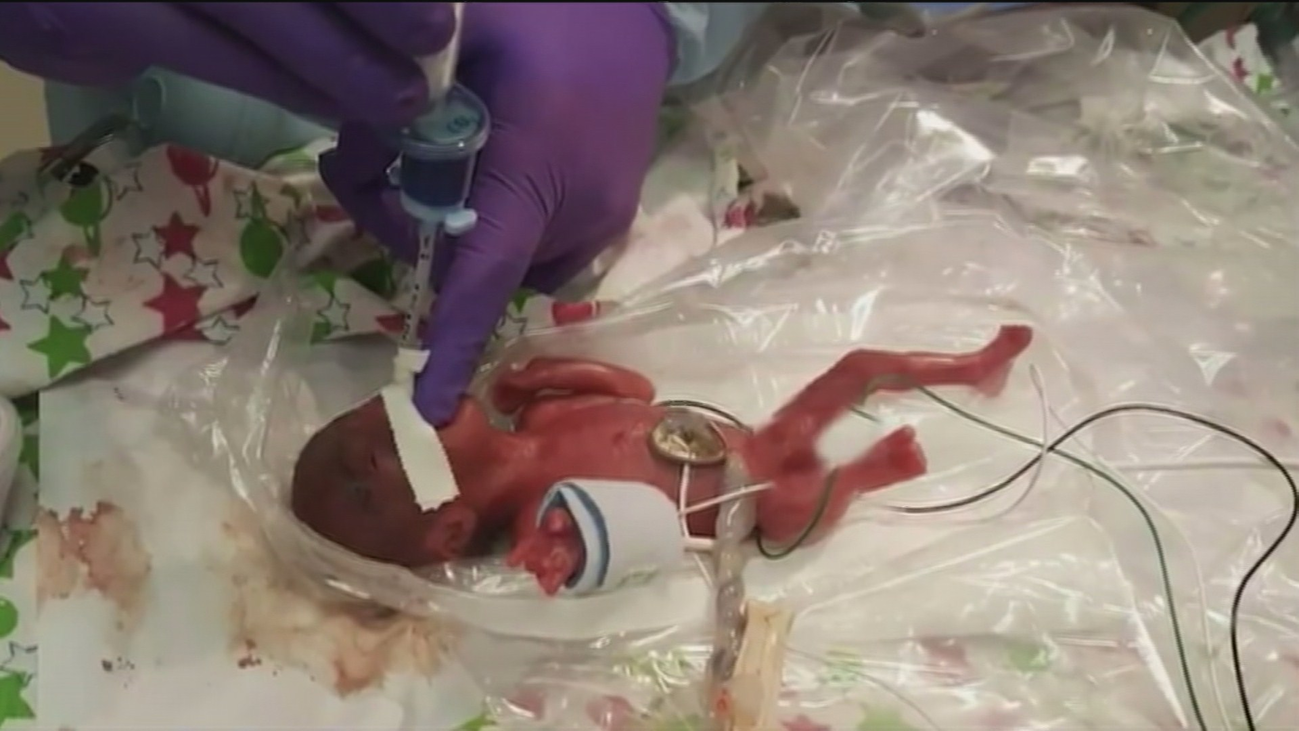 Sobrevive la bebé más pequeña del mundo: 243 gramos al nacer