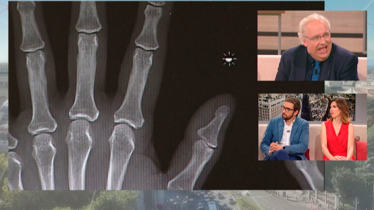 Siete millones de personas en España padecen artrosis