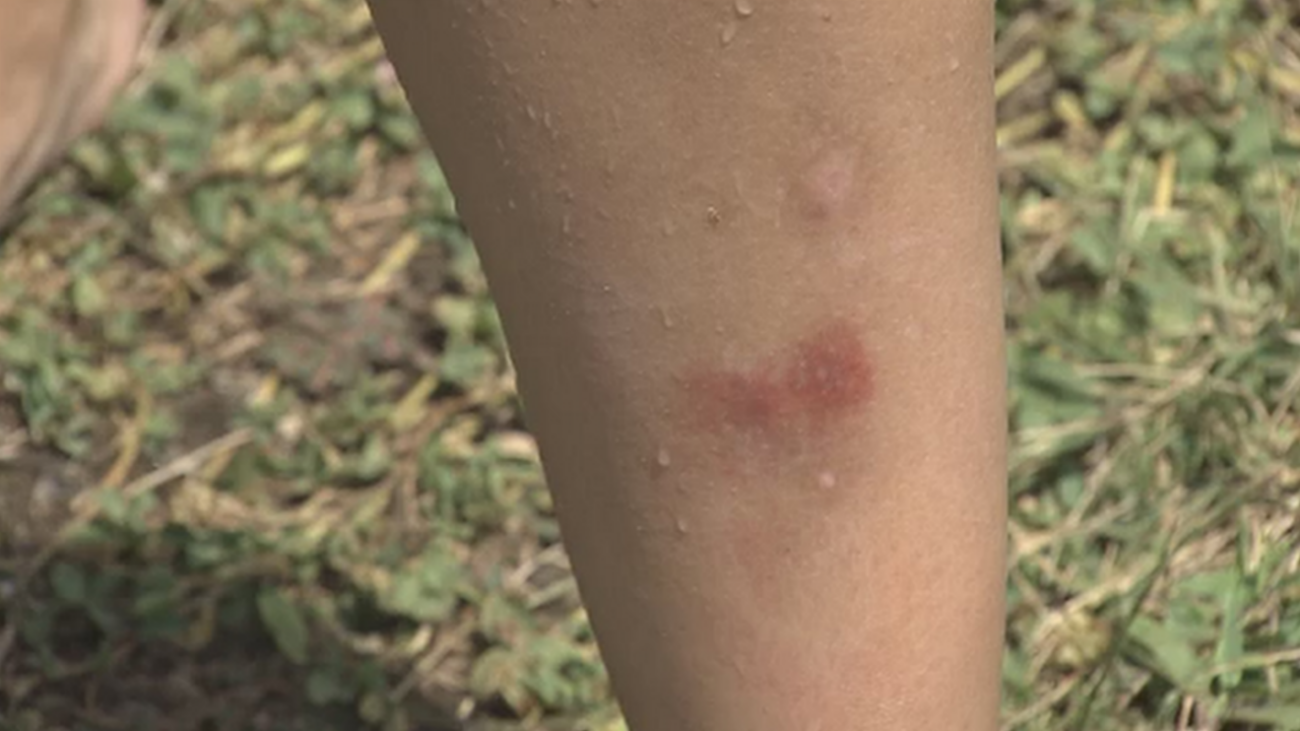 El kit perfecto para acabar con las picaduras de mosquitos cuesta menos de 15€