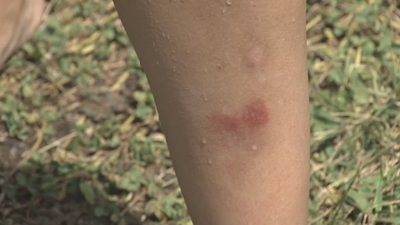 El kit perfecto para acabar con las picaduras de mosquitos cuesta menos de 15€