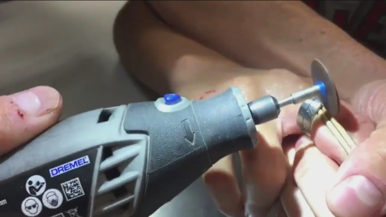 Retiran con una sierra radial un anillo a un niño en Parla