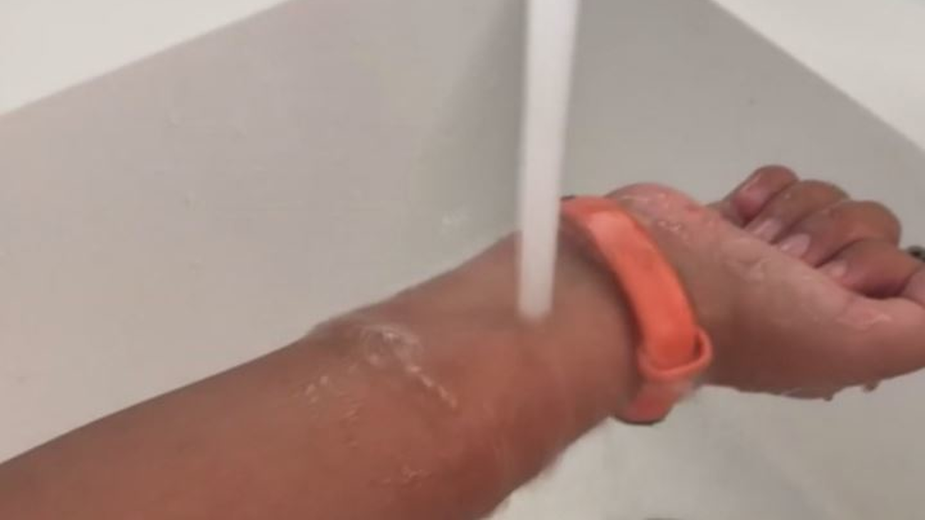 Cómo actuar tras una quemadura solar