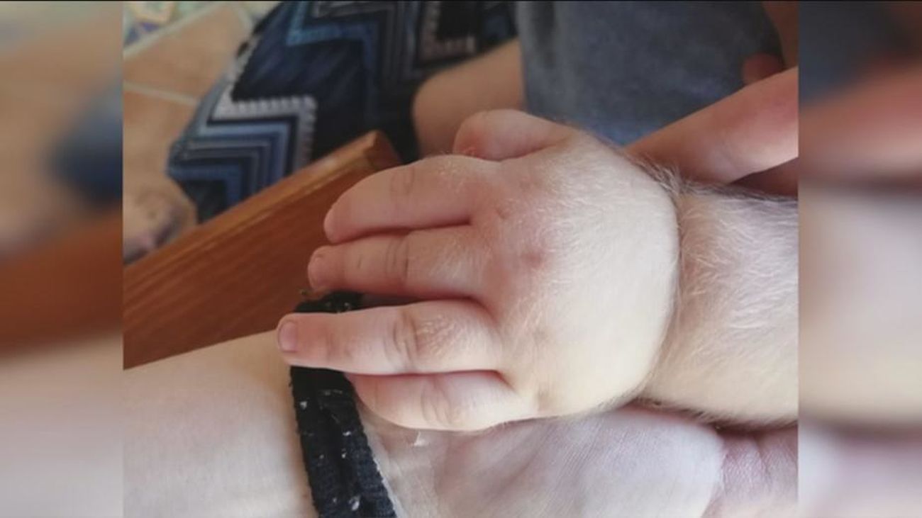 Niño afectado por hipertricosis