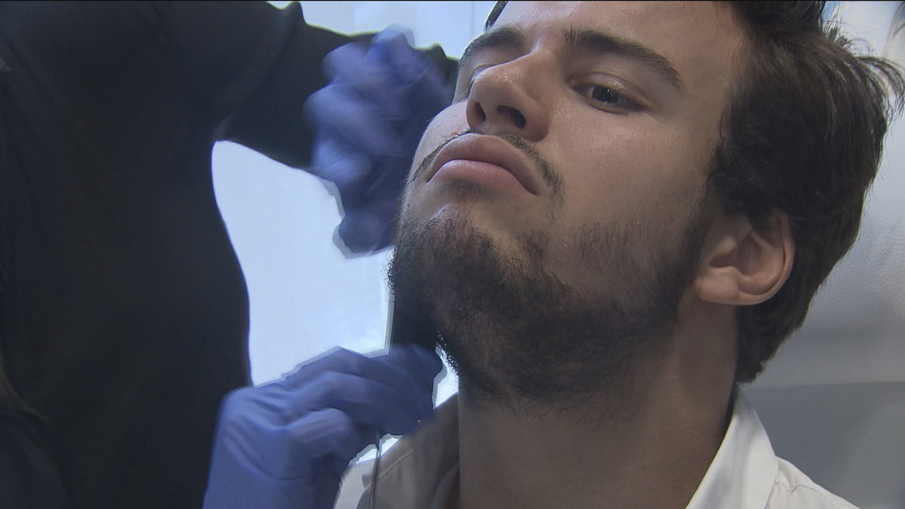 Injertos para repoblar la barba, la última tendencia