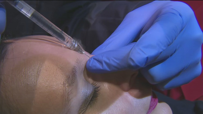 Rinomodelación, la solución a los retoques en la nariz sin pasar por quirófano