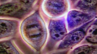 Secuencian el genoma completo de los tumores metastásicos