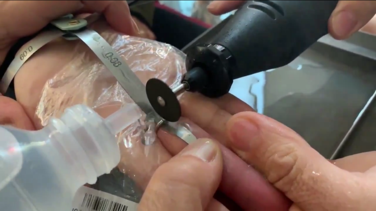 Retiran un anillo de un dedo hinchado