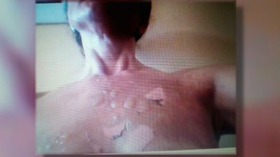 La mujer con quemaduras en cara y pecho por la Thermomix aún no puede hacer vida normal