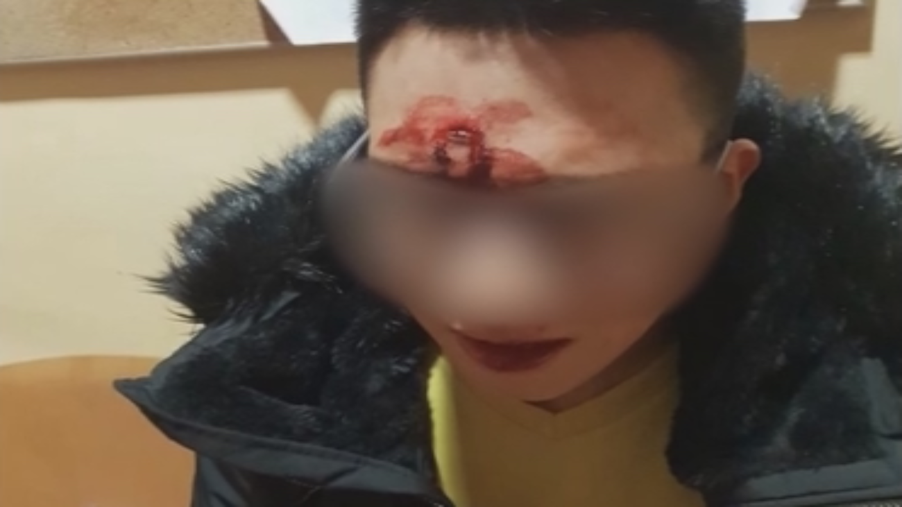 Le destrozan la cara para robarle el móvil en Colmenar Viejo