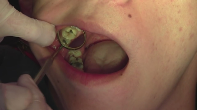 Los excesos de los dulces de Navidad provocan el 50% de las caries