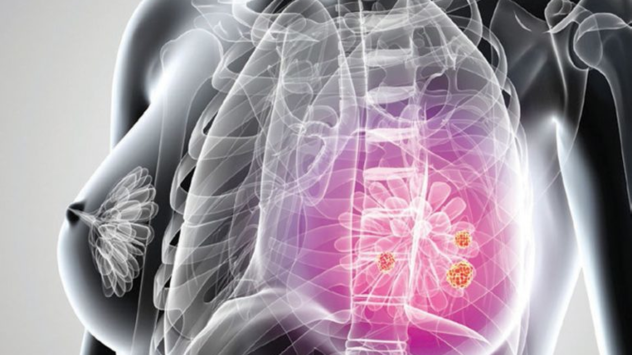 La cirugía oncoplástica permite la conservación de la mama en caso de cáncer