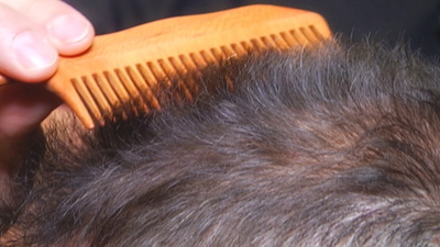 Los injertos de pelo, un negocio en auge en Madrid