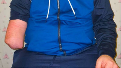 El trabajador que perdió un brazo en una empresa de Meco: "Me siento abandonado"