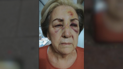 Así ha quedado tras tropezarse con una acera en mal estado de Carabanchel