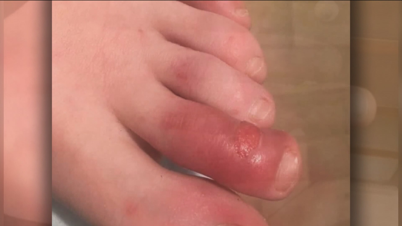 Investigan si la aparición de sabañones en niños puede ser un síntoma de covid-19