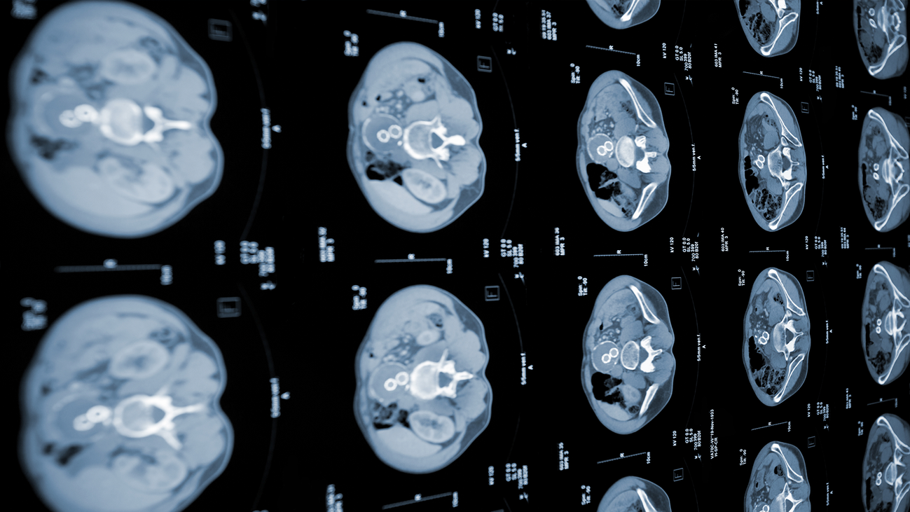 Descubren que la diabetes tipo 3 C es una manifestación temprana del cáncer de páncreas