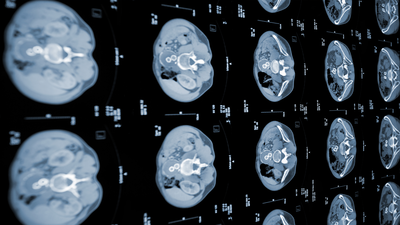 Descubren que la diabetes tipo 3 C es una manifestación temprana del cáncer de páncreas