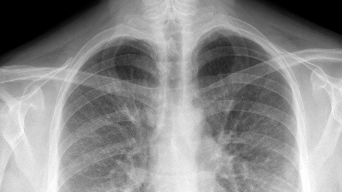 ¿Qué conclusiones se han obtenido de las autopsias a fallecidos por coronavirus?