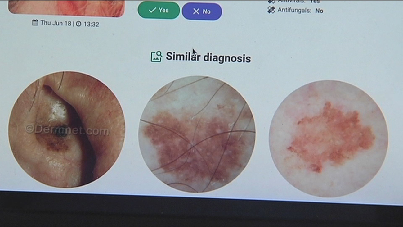 Una aplicación de móvil para detectar un melanoma a partir de una fotografía