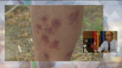 Acribillado con hasta 50 picaduras de mosca negra en Aranjuez