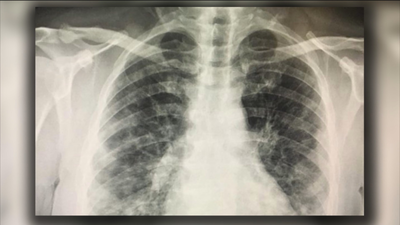 Un "regalo" reciente de cumpleaños: enfermarse de Covid-19