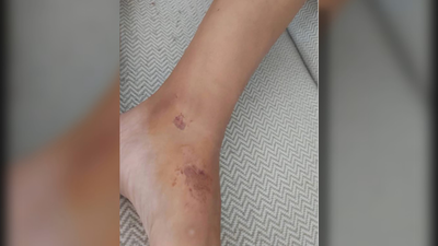 Cae dentro de una alcantarilla sin tapa de Aranjuez y se rompe las costillas