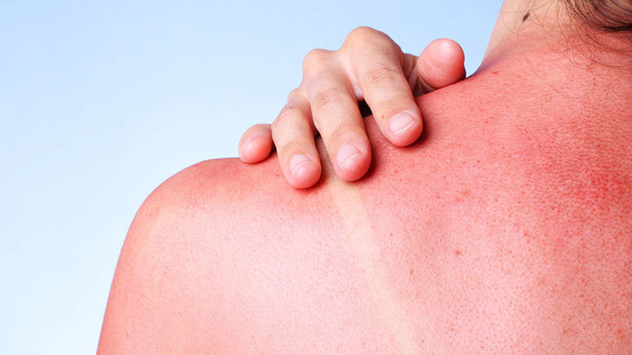 Enfermedades de la piel en verano