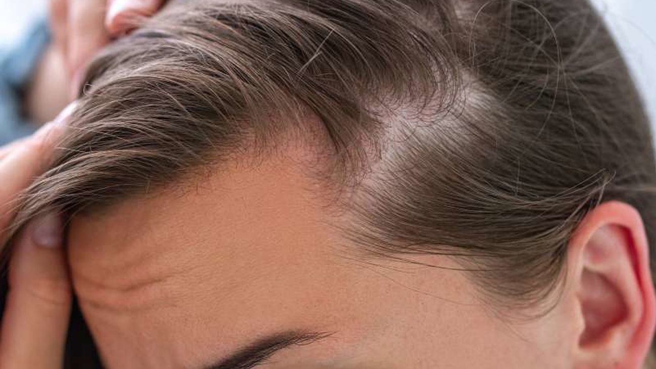 Alopecia en las mujeres