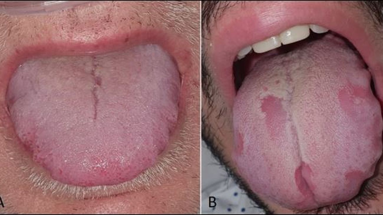Imagen de la 'lengua Covid' que provoca el coronavirus