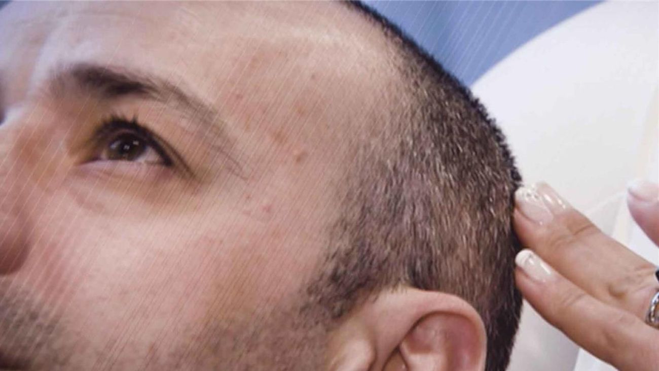 Ya no hace falta irse a Turquía: en Madrid ya encontramos clínicas ‘low cost’ de injerto de pelo