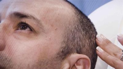 Ya no hace falta irse a Turquía: en Madrid ya encontramos clínicas ‘low cost’ de injerto de pelo