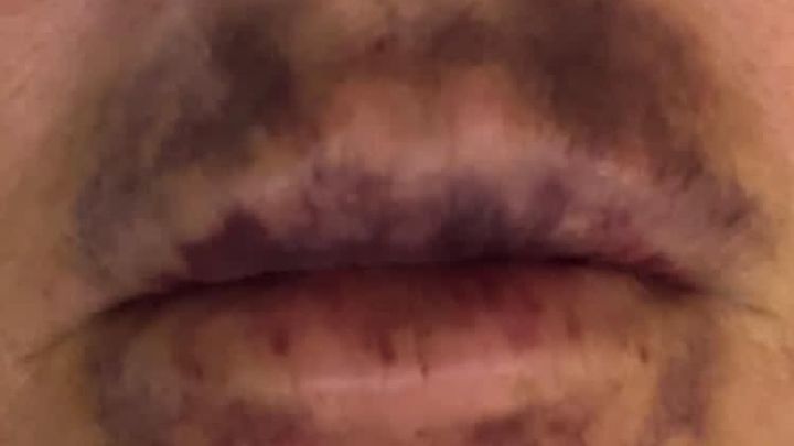 Daños producidos en los labios de una mujer que utilizó el falso cosmético / Policía Nacional