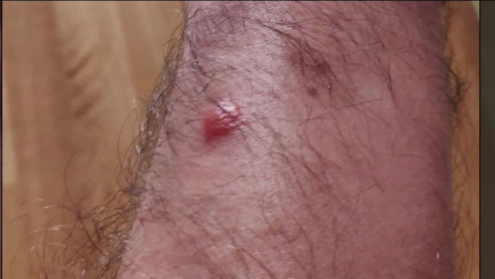 madrid directo picadura / Madrid Directo