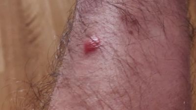 Un año más, los vecinos de Perales del Río sufren las picaduras de la mosca negra