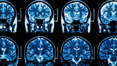 Un estudio no encuentra signos de lesión cerebral permanentes a largo plazo tras sufrir la Covid-19