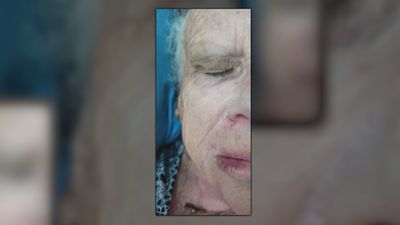 Una vecina de 81 años sufre una caída por el pésimo estado de las aceras, en Alcorcón