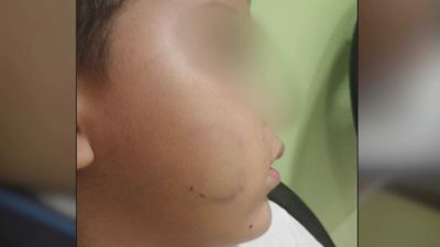 Un niño de 3 años recibe mordeduras por todo el cuerpo