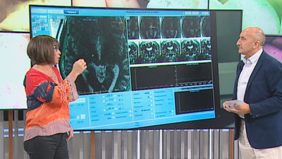 Una técnica de ultrasonidos desarrollada por HM Hospitales ayuda en la terapia contra el párkinson