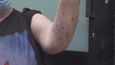 Desalojan un hostal ilegal por una plaga de chinches, en Tetuán